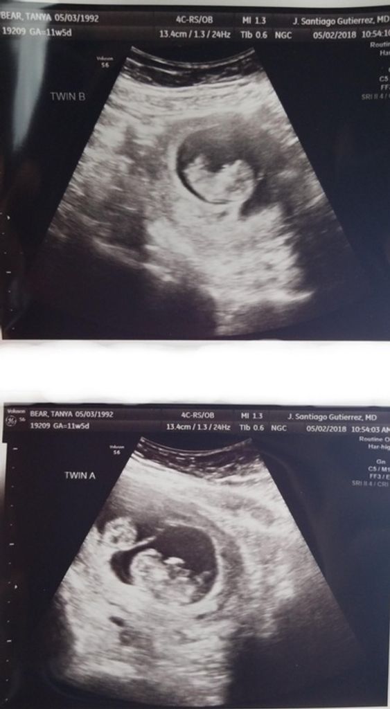 Twin Babies, Rael & Rolando Villarreal-Bear Profile Photo